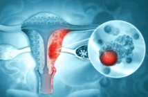 Cómo prevenir el cáncer de cuello uterino