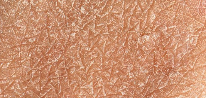 Qué diferencias permiten distinguir el eccema de la piel seca cuando la picazón persiste y altera el descanso nocturno